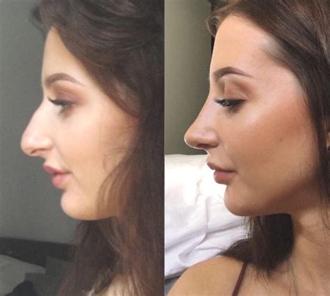 I had a rhinoplasty 2 months ago and pretty much the whole time Ive had this rotting flesh smell only on one side. . Boogers after rhinoplasty reddit